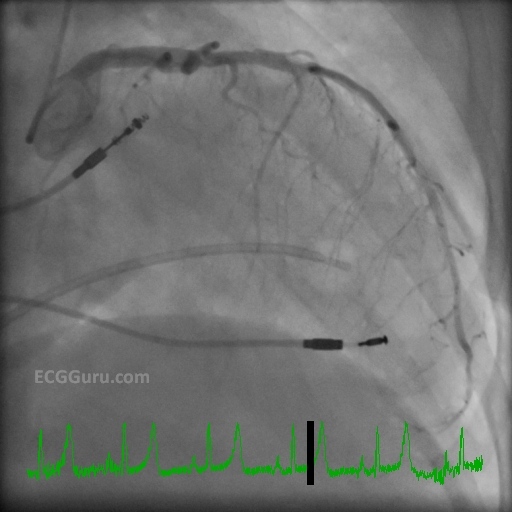 Angiogram. Diseased Left Coronary Artery, Pacemaker, Swan Ganz Catheter ECG Guru Instructor